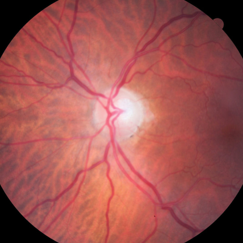How to improve glaucoma referrals
